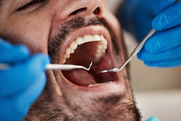 Best Emergency Wisdom Teeth Removal in Berwyn, IL